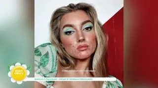 Modelki z trądzikiem - jak zmieniają się trendy w świecie mody?