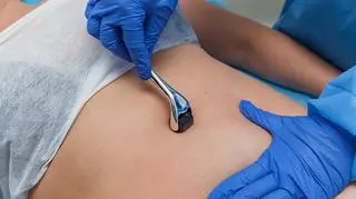 karboksyterapia