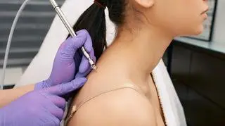 elektrokoagulacja zabieg