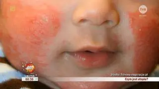 Masz atopowe zapalenie skóry? Nie stresuj się