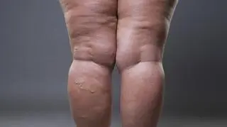 Lipoedema, lipodemia, lipedema. Co to za choroba?