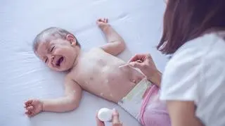 Dziecko chore na odrę, smarowane lekarstwem przez matkę