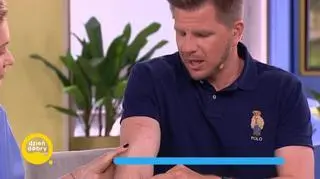 Filip Chajzer pokazał blizny. "To herbata. Babcia ją na mnie niechcący wylała". Ekspert wskazał najgorszy błąd przy oparzeniach