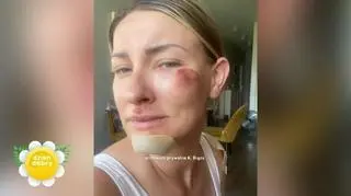 Kasia Bigos miała wypadek. Kask rowerowy uratował jej życie