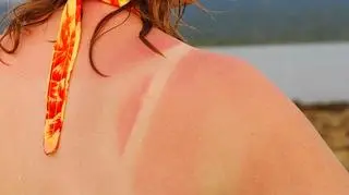 skóra ze śladami po opalaniu