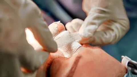Rhinoplastyka, czyli operacja plastyczna nosa i prostowanie przegrody nosowej - czy warto?