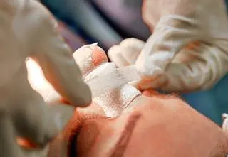 Rhinoplastyka, czyli operacja plastyczna nosa i prostowanie przegrody nosowej - czy warto?