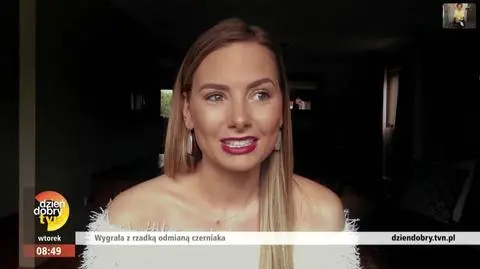 Przez lata robiła akrylowy manicure. O mały włos nie przegapiła czerniaka 