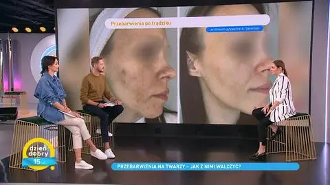 Jak usunąć przebarwienia na twarzy? Poznaj rady eksperta