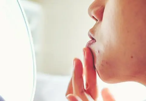 Pokazywanie trądziku - nowy trend na Instagramie. Co to jest skinpositivity?