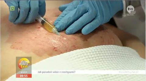 Jak pozbyć się rozstępów?