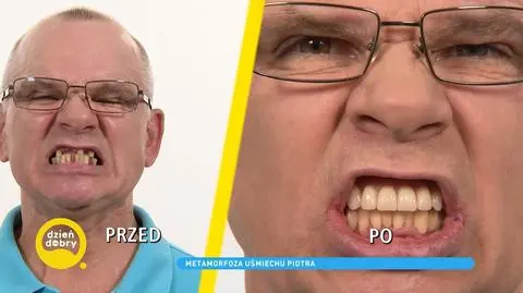 Łańcuch kombajnowy pozbawił go zębów. Dzięki temu zabiegowi ma piękny uśmiech