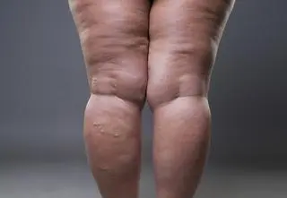 Lipoedema, lipodemia, lipedema. Co to za choroba?