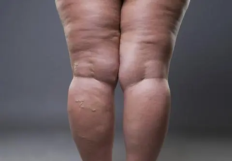 Lipoedema, lipodemia, lipedema. Co to za choroba?