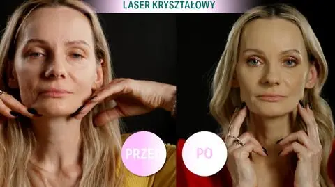 Efekty użycia lasera kryształowego - przed i po metamorfozie