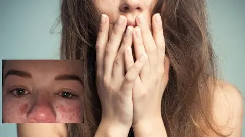 Gwiazda "Big Brothera" trafiła do szpitala po wypróbowaniu triku z TikToka