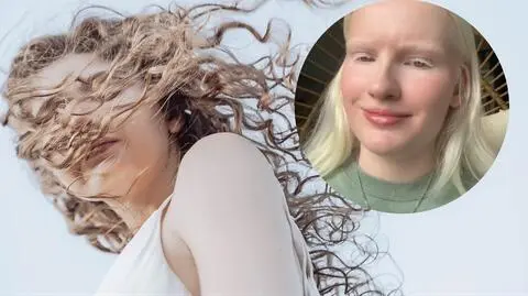 Tiktokerka z albinizmem