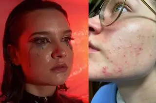 Julia Chatys o swoich problemach z cerą