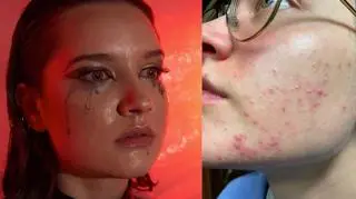 Julia Chatys zmaga się z trądzikiem