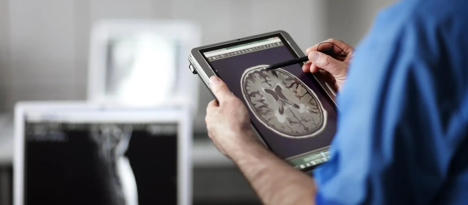 Udar mózgu – jak się przed nim uchronić? 