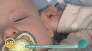 Wyjątkowa operacja bliźniąt