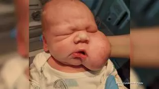 Ogromny guz twarzy noworodka