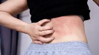 Jak wyleczyć atopowe zapalenie skóry? Terapia Enderleina