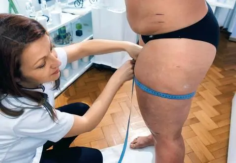 Rówieśnicy wyśmiewali jej "twarogowe" nogi. Lekarze zdiagnozowali chorobę 