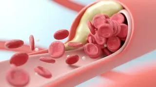 Mikroplastik sprzyja miażdżycy - ale tylko u tej płci