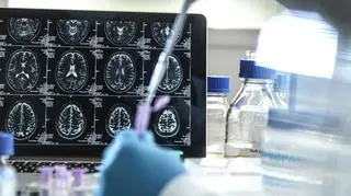 19-latek miał problemy z nauką. Lekarze zdiagnozowali u niego Alzheimera. "To najmłodszy przypadek"