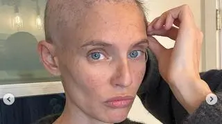 Bianca Balti pokazała, jak zmieniła ją choroba 