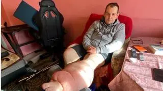 Nogę pana Pawła od lat pokrywają bolesne guzy. "Jeśli nie znajdę pomocy, to obetnę sobie nogę"
