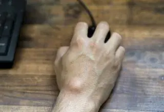 Ganglion - co to jest? 