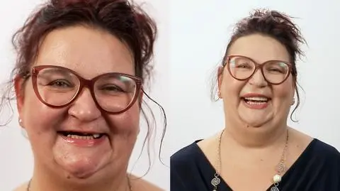 Metamorfoza uśmiechu Joanny. "Pijąc kawę, wypadły mi dwa zęby"