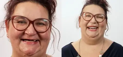 Metamorfoza uśmiechu Joanny. "Na przyjęciu weselnym wypadła mi proteza"