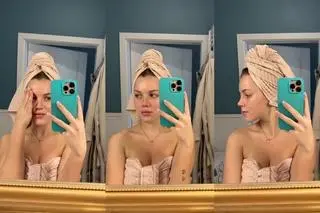 Klaudia Bigus po operacji nosa