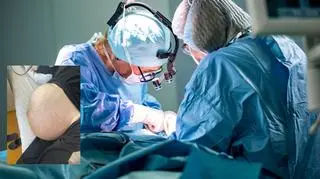 W jej ciele rósł gigantyczny guz. Ważył około 20 kilogramów. "Pacjentka przeszła bardzo rozległą operację"