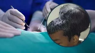 Lekarze usunęli rekordowego guza mózgu. "Wyglądał, jakby miał dwie głowy"