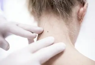 Miała szyję wygiętą pod kątem 90 stopni. Skomplikowana operacja uratowała życie 13-latki 