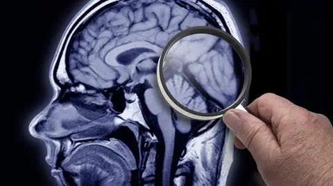 6 czynników, które przyspieszają proces starzenia się mózgu