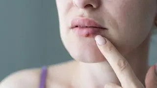 Popularny lek na opryszczkę wycofany z obrotu. "Do GIF wpłynęła informacja wskazująca na wystąpienie wady jakościowej"