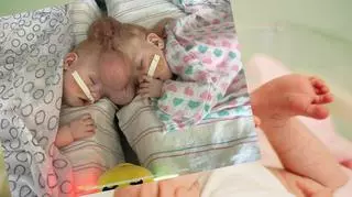 Po urodzeniu przeszły skomplikowaną operację. Dziś bliźniaczki syjamskie mają 5 lat i żyją jak ich rówieśnicy 