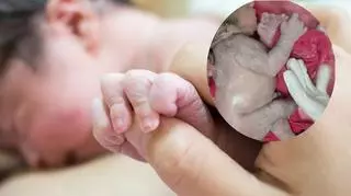 Na świat przyszło dziecko z trzema rączkami. Dodatkową kończynę ma w nietypowym miejscu