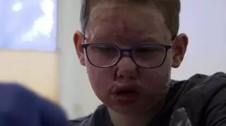 10-letni Tomek utknął w płonącym samochodzie. “Często powtarza, że ma dość cierpienia”