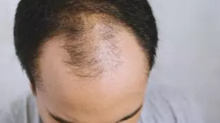 Japońscy badacze wyhodowali mieszki włosowe. Czy czeka na przełom w walce z łysieniem? 