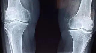 "Kość w proszku" może zrewolucjonizować medycynę. Wynalazek polskich naukowców