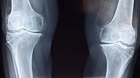 Sztuczna "kość" może zrewolucjonizować medycynę