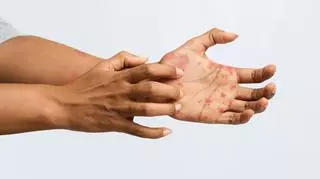 Osoba drapiąca się po dłoniach
