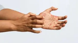 Osutka – przyczyny i rodzaje. W jakiej postaci występuje?
