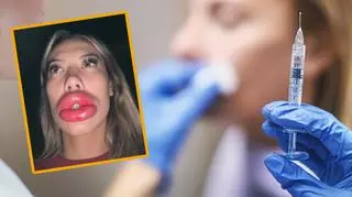 24-latka zapragnęła większych ust. Tragiczne kulisy zabiegu opisała w sieci 